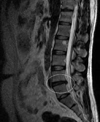 Herniated lumbar disc